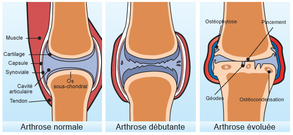 différentes douleurs de genou osteo osteopathie rotule ménisque tendon ligament