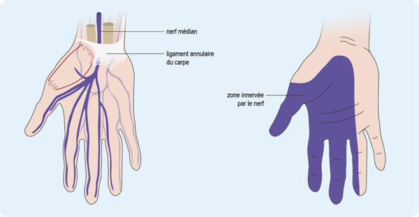 Symptômes symptomes douleur syndrome canal carpien osteo osteopathie ostéo ostéopathie main poignet