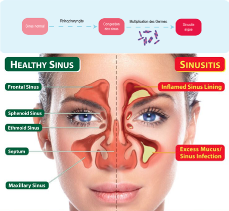 sinusite sinus frontal maxillaire sphenoidal ethmoidal osteo osteopathie ostéo ostéopathie nez bouché