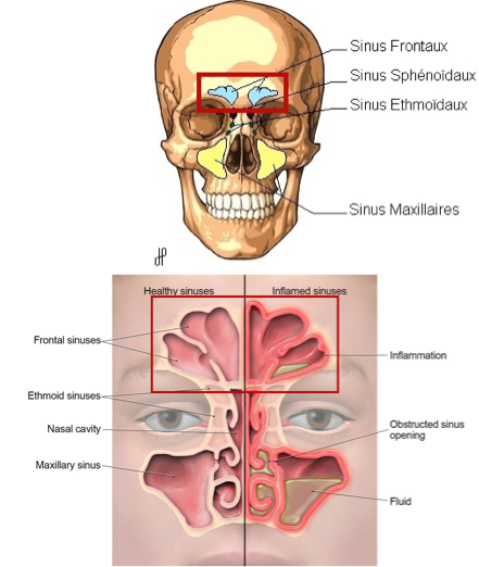 sinusite frontale front sinus nez bouché osteo osteopathie ostéo ostéopathie