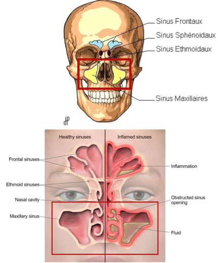 sinusite maxillaire sinus nez bouché ostéo ostéopathie osteo osteopathie