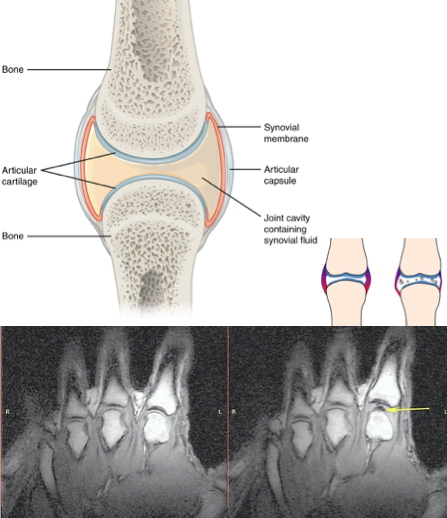 Craquement articulaire articulatioin doigt dos synovie cavitation cavite gaz osteo osteopathie ostéo ostéopathie