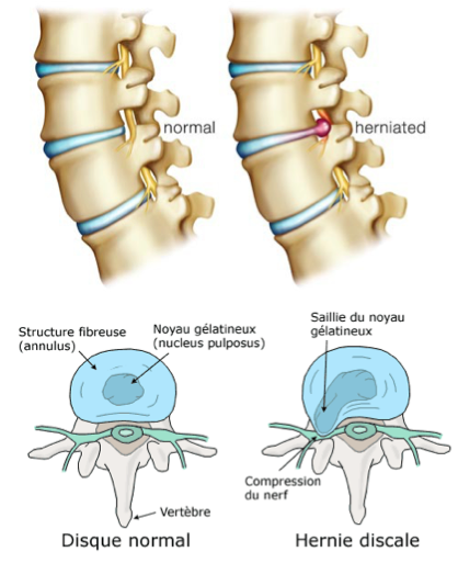hernie discale sciatique cruralgie lumbago lombalgie osteo osteopathie ostéo ostéopathie anatomie fonctionnement mécanisme lombosciatique