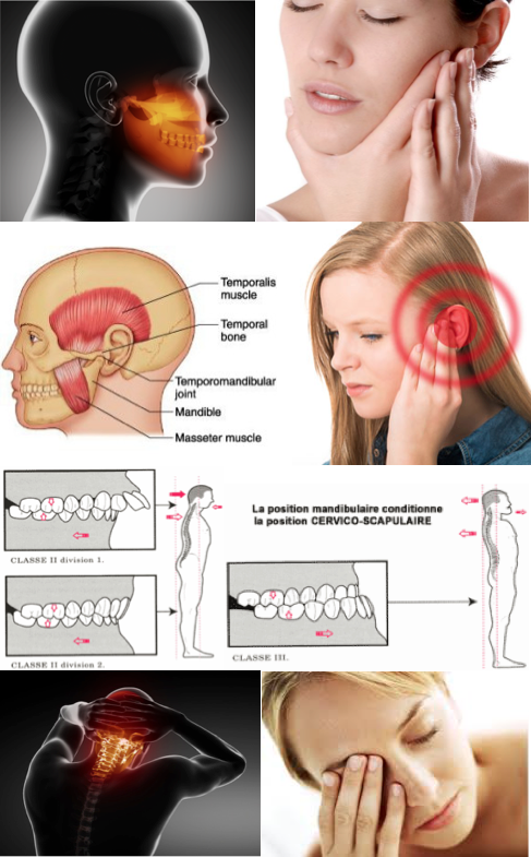 Articulation temporo-mandibulaire (ATM): - MAËVA GUIRAL RUPÉ OSTÉOPATHE D.O  NICE