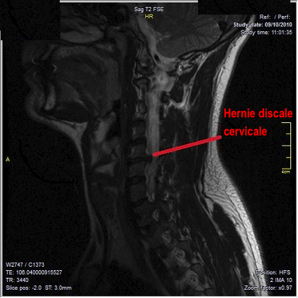 névralgie cervico-brachiale NCB sciatique bras cause cou osteo osteopathie ostéo ostéopathie