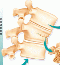 osteo osteopathie ostéo ostéopathie traitement soin bien être examen complémentaire radio radiographie IRM scanner tassement vertébral fracture corps vertébral