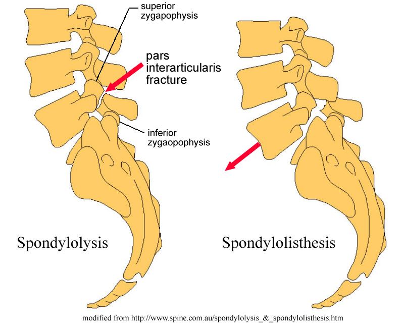 osteo osteopathie ostéo ostéopathie bien être soin traitement examen complémentaire IRM radio radiographie scanner spondylolisthésis lyse isthmique spondylose spondylolisthésis arthrosique