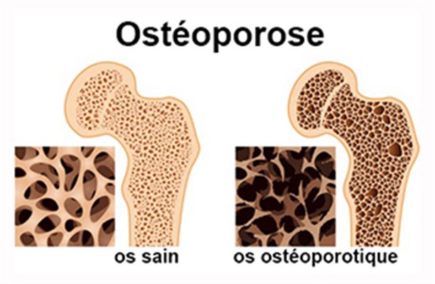 osteo osteopathie ostéo ostéopathie traitement bien être soin examen complémentaire radio radiographie IRM scanner ostéopénie osteopenie ostéoporose osteoporose perte de densité osseuse déminéralisation osseuse demineralisation fragilité os